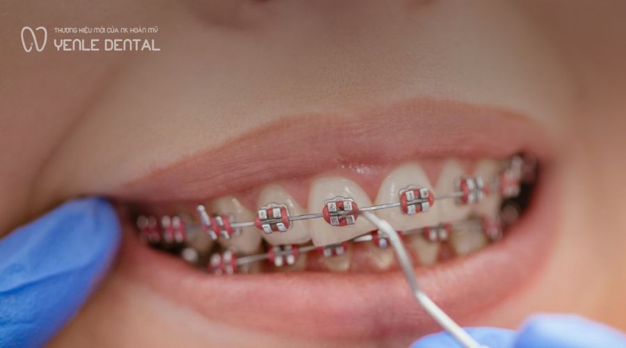 tụt lợi khi niềng răng